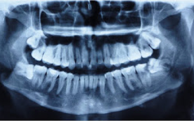 Dentes do Siso