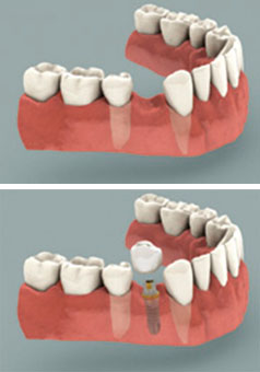 o que e um implante dentario